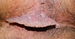 women-thong-cure-for-anal-warts-nude-wallpaper