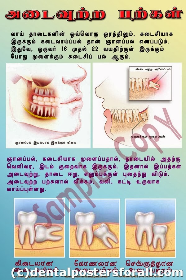 Dental Posters to Educate Patients Impaction in Tamil