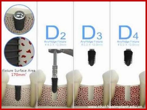 ĐÁNH GIÁ TIÊU CHUẨN CHẤT LƯỢNG XƯƠNG HÀM TRONG CẤY GHÉP IMPLANT -3
