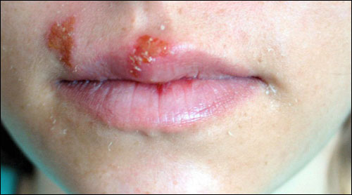 makanan untuk penyakit herpes