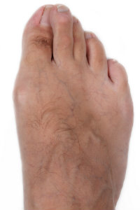 overlapping toes