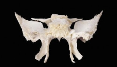 sphenoid bone