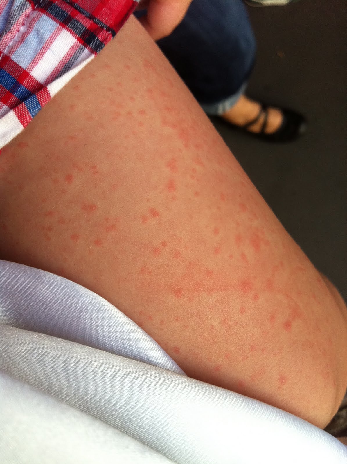 Playing the Davelines Apparently you get Heat Rash.....