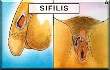 Gejala Penyakit Sipilis