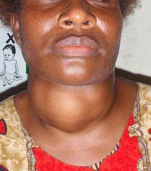Goitre Enlarged Thyroid Gland Classes Causes Signs And Symptoms