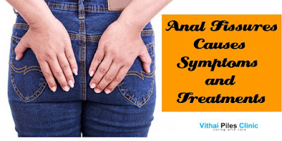 fissure treatment without surgery, symptoms of Anal fissure, causes of anal fissure, what is anal fissure, fissure treatment, Anal Fissure, hemorrhoid fissure
