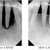 Laser-assisted New Attachment Procedure