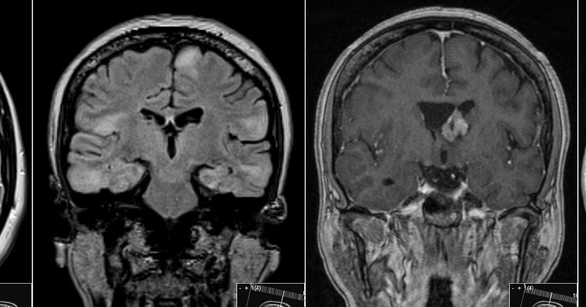 Radiology MRI Tuberous Sclerosis