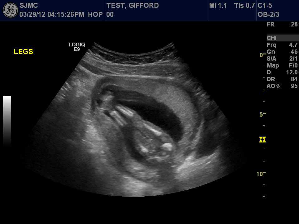 baby-gifford