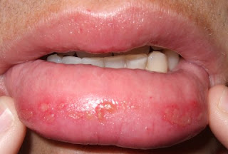 lips herpes blisters sun symptoms swollen poisoning simplex blistered lip sunburned mouth treatment rash itching finger hsv remedies fast worse