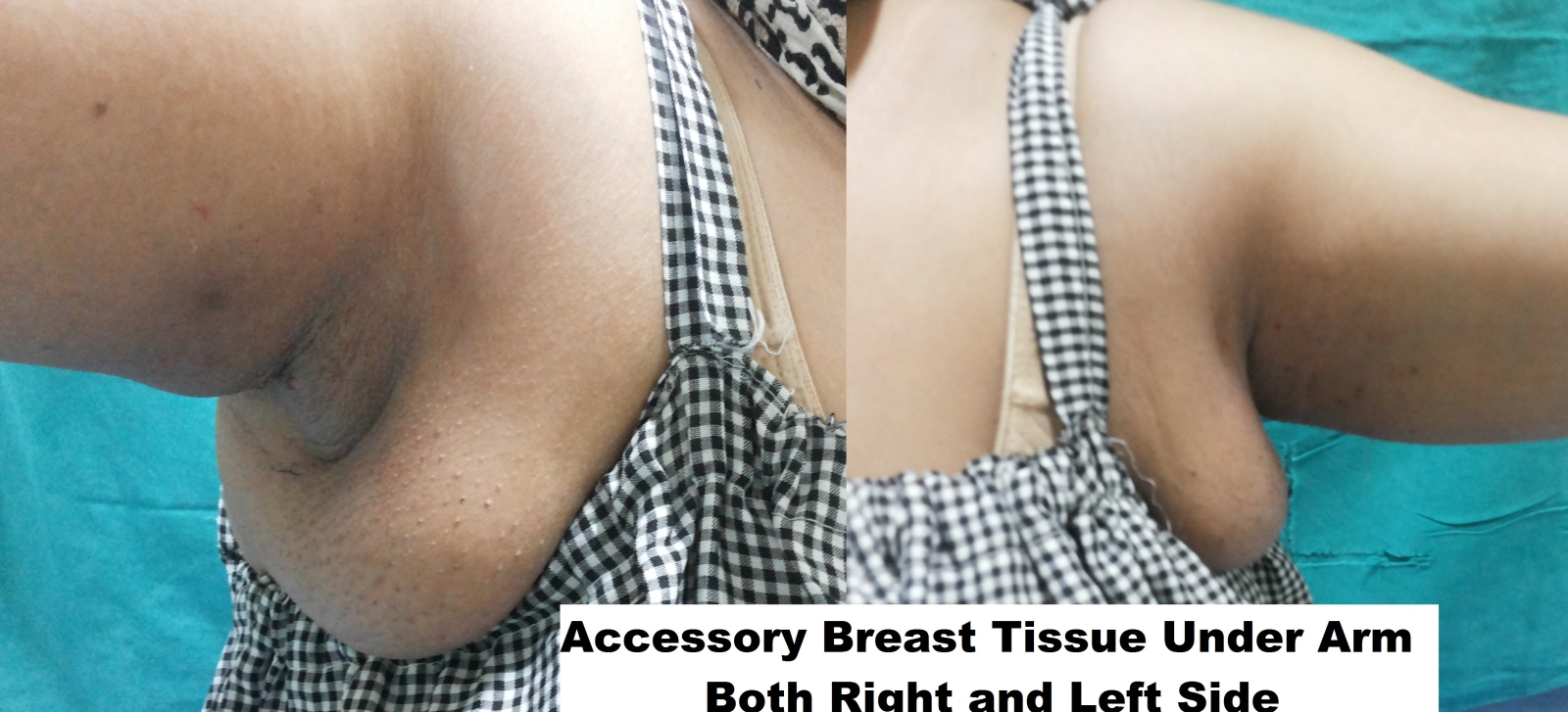 South Delhi Cosmetic Clinic Best Cosmetic Surgery Clinic In Delhi What Is Accessory Breast Underarm In Women And Its Treatment