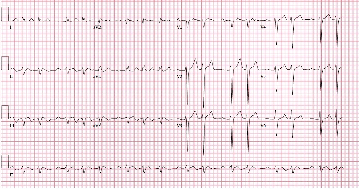 ECG Rhythms The groupbeating
