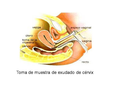 Toma de muestra exudado de cervix