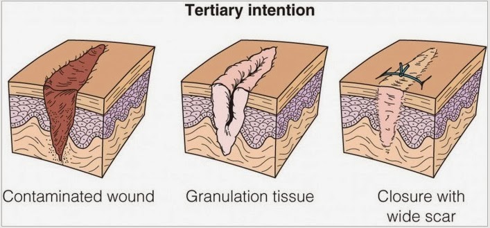 HEiDiMatEs MeDICinE General Principle Of Management For Open Fracture