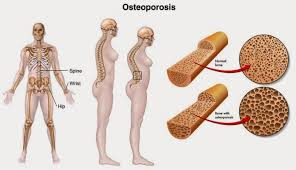 Faktor Risiko Dan Dampak Berbahaya Osteoporosis Pada Tubuh