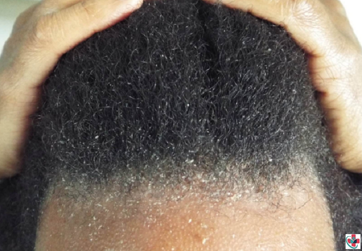 Natural Treatments for Dandruff