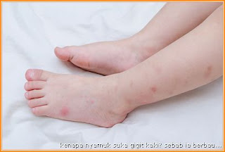 Gambar nyamuk gigit kaki bayi. Bagaimana elakkan nyamuk gigit kaki?