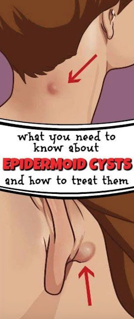 Here’s What You Need To Know About Epidermoid Cysts And How To Treat Them