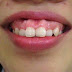 Răng hô có niềng răng được hay không ?