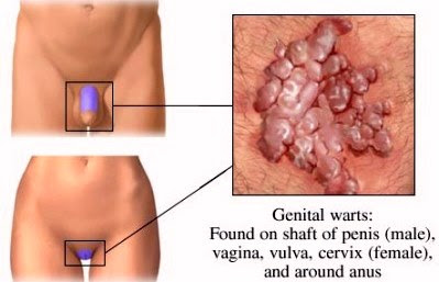Advise Anal warts type of doctor Anal warts type of doctor