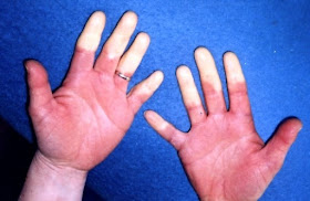 Raynaud’s syndrome