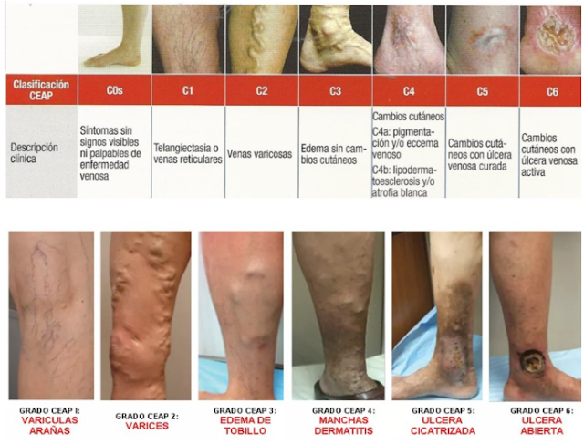 tratamentul varicozei pe scena iniiala a picioarelor