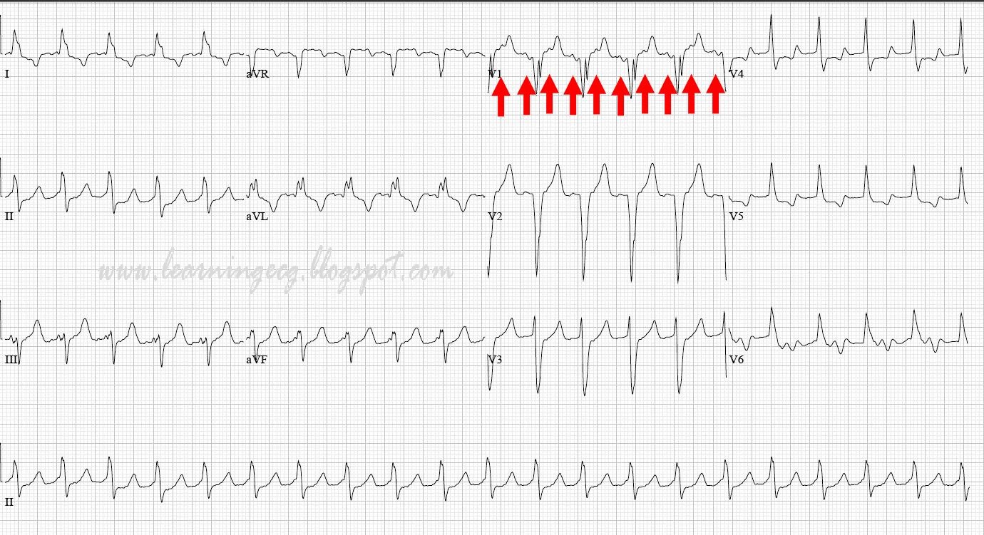 Ecg Rhythms Atrial Flutter The Great Mimic | The Best Porn Website