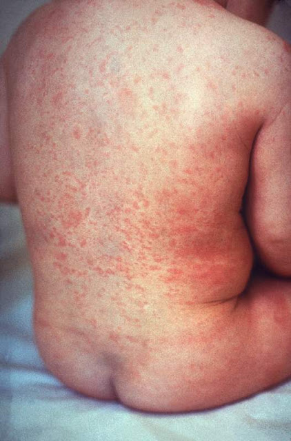a patient with rash