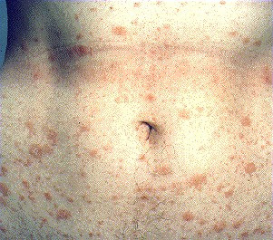 Cat Scratch Inflammation Cat Scratch Inflammation