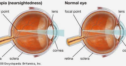 examene oculare regulate miopia este o boala