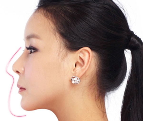Phương pháp sửa mũi như nào mới đẹp và an toàn Phuong-phap-sua-mui-nhu-nao-moi-dep-va-an-toan-2
