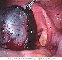 Endometriosis, البطانة الهاجرة,بطانة الرحم الهاجرة