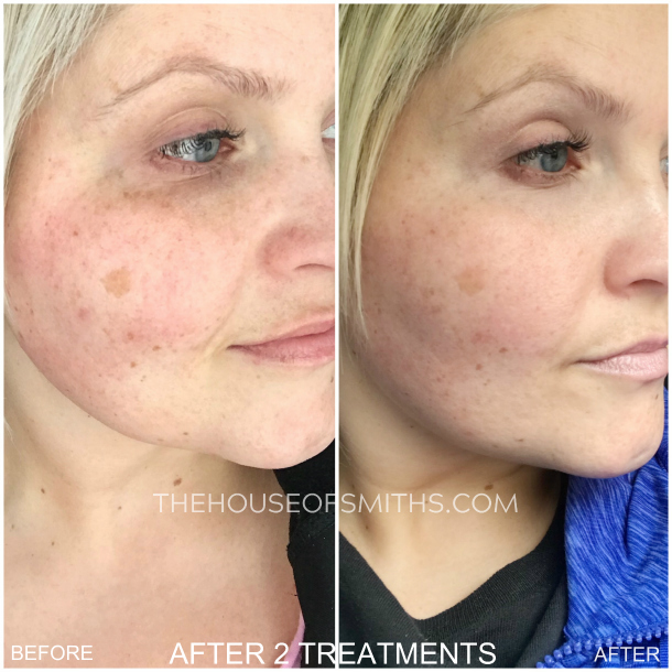 SelfCare, Microneedling + Before & Afters