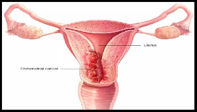  ما هي اعراض سرطان الرحم ؟ اهم اعراض سرطان الرحم - الجنان