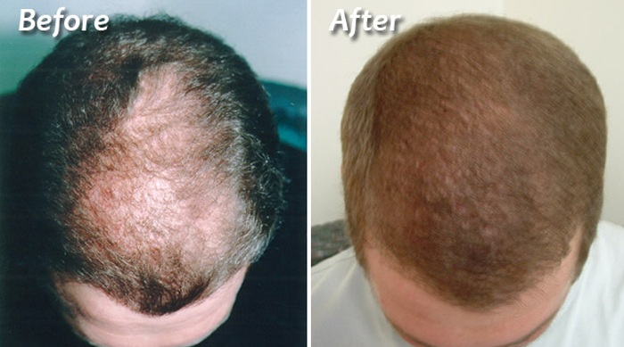 Tricho360 Hair Transplant In Gurgaon Haryana November 2017
