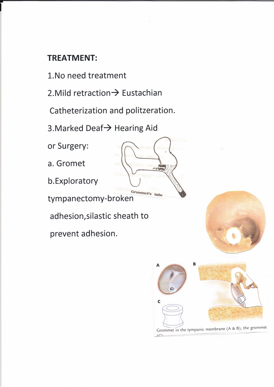 المدونة الطبية د.فهيد سالم السبيعي ADHESIVE OTITIS MEDIA