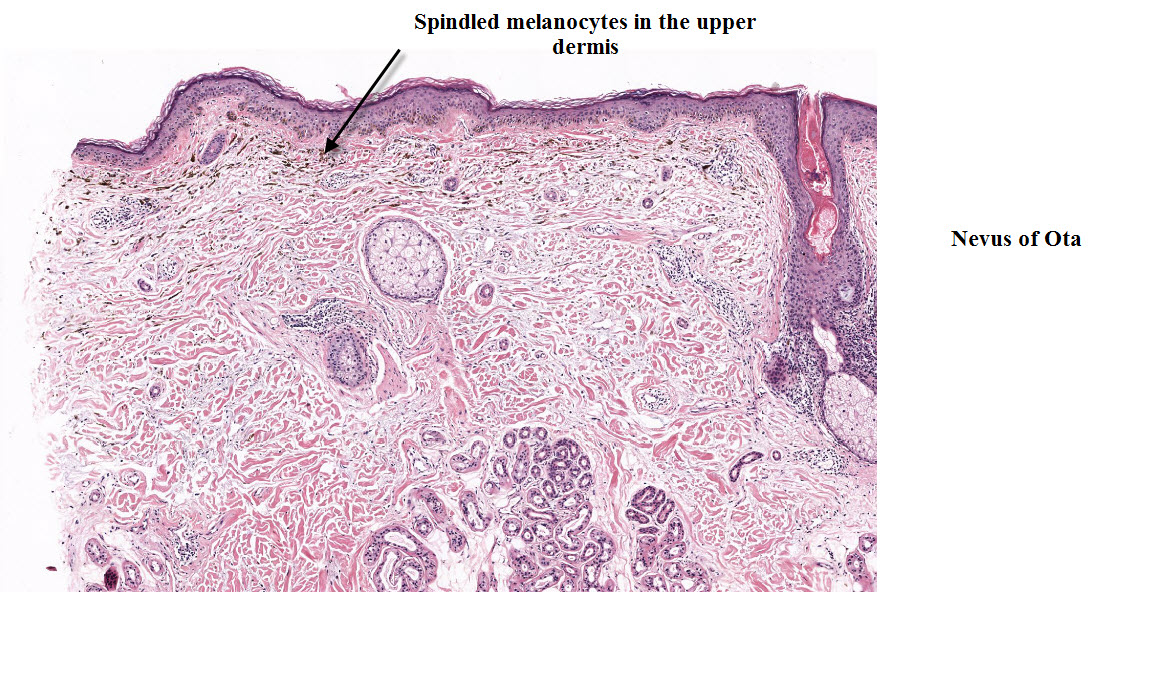 Dermpath Made Simple - Neoplastic: Benign Pigmented Lesions - Solar ...