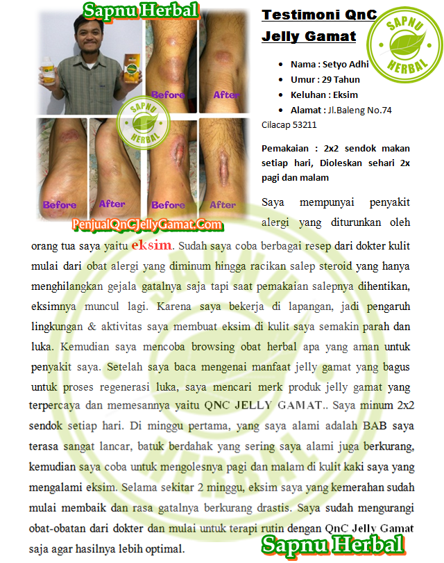 Cara Mengobati Dermatitis Atopik Secara Alami Terbukti Ampuh ~ TESTIMONI QNC JELLY GAMAT Cara Mengobati Dermatitis Atopik Secara Alami Terbukti Ampuh ~ TESTIMONI QNC JELLY GAMAT