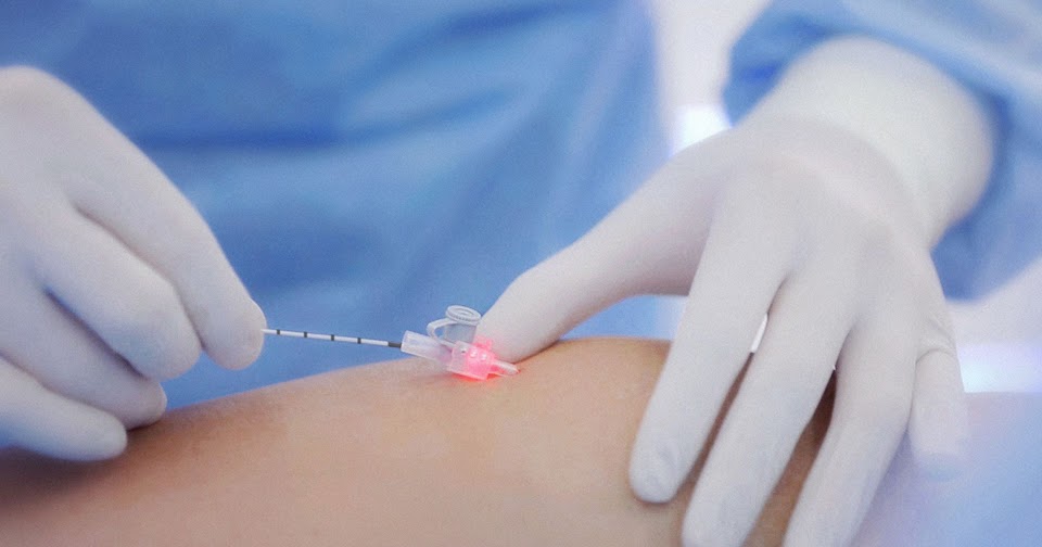 Cyanoacrylate Glue Obstruction for Varicose Veins