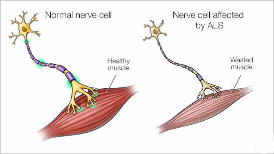 ALS, amyotrophic lateral sclerosis