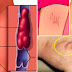 BABALA: 9 Na Napakadelikadong Senyales Na Meron Na Kayong Blood Clot, Wag Babalewalaen