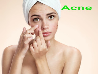 Acne, treatment