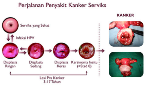 Lidiah Blog: KANKER SERVIKS