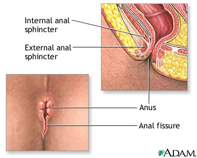  anal fissure homeopathy treatment in chennai