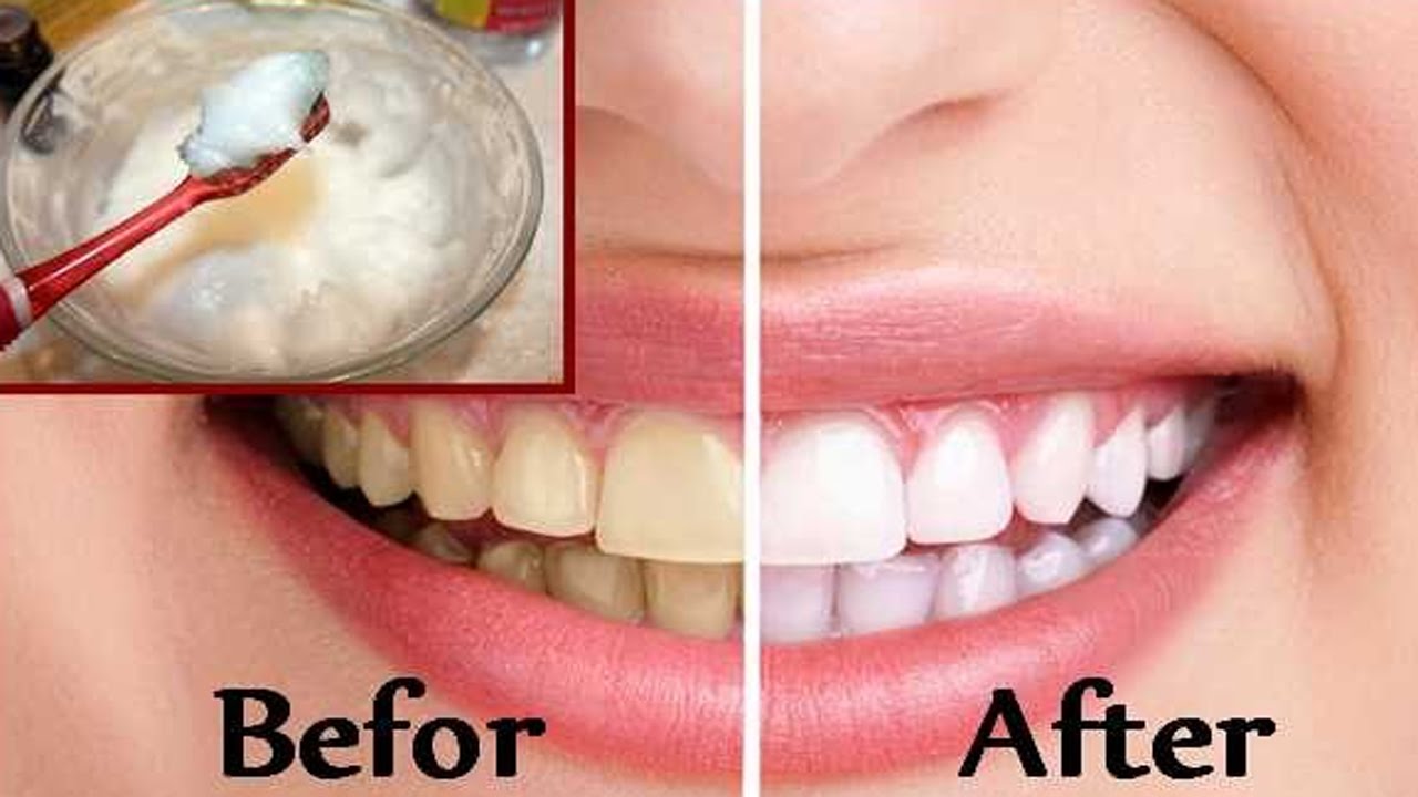 Best Way To Whiten Your Teeth With Baking Soda Teeth Poster