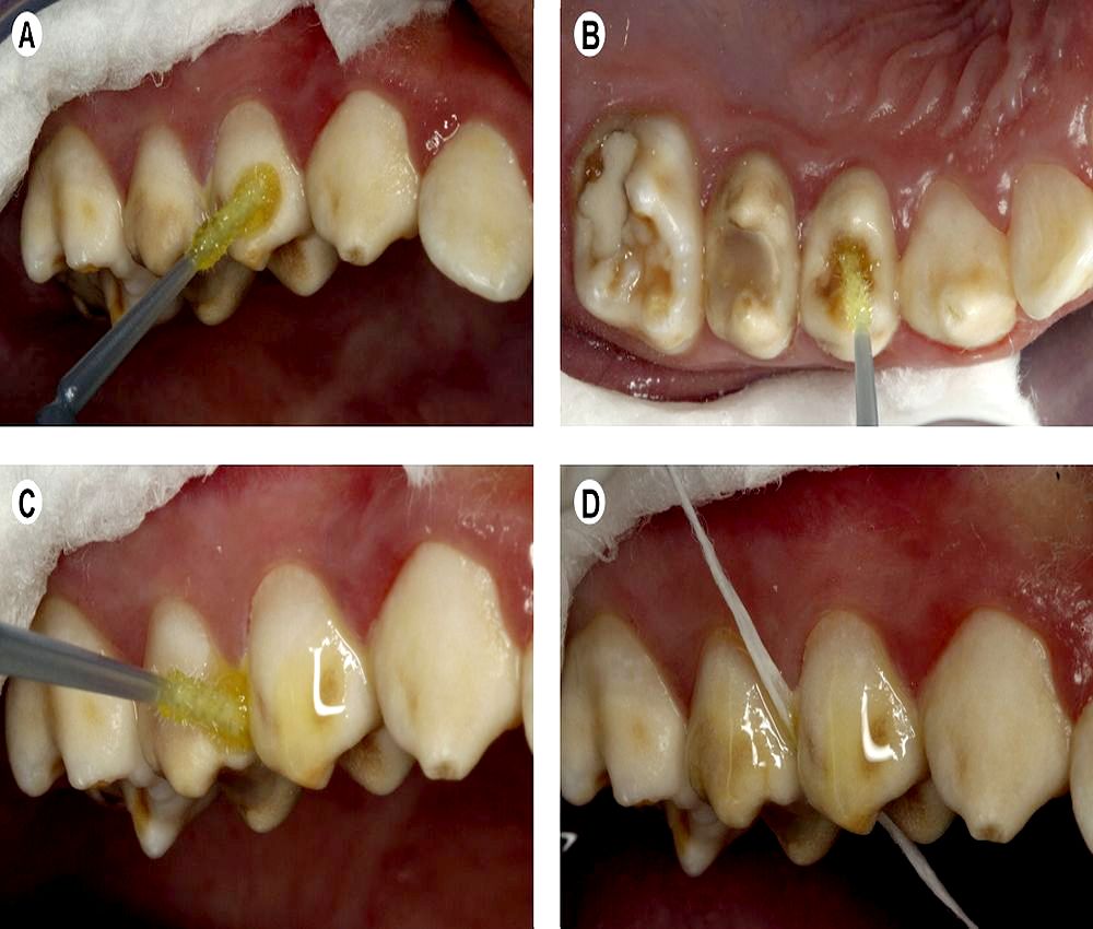ORAL MEDICINE Immediate desensitization in teeth affected by