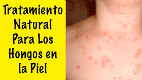 tratamiento para infecciones en la piel por hongos