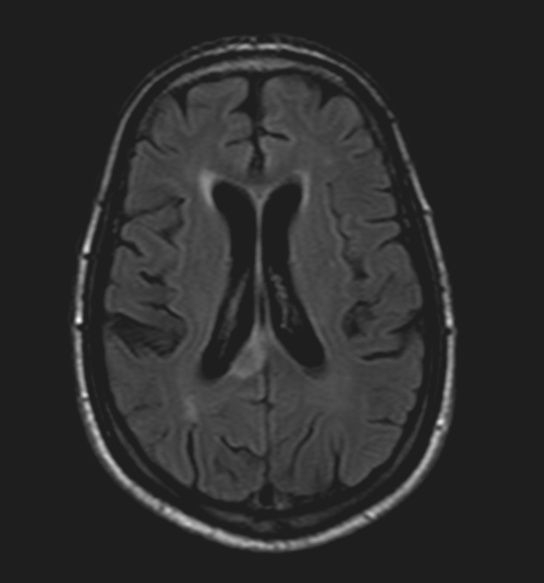 Corpus Callosum InfarctionMRI Sumer's Radiology Blog