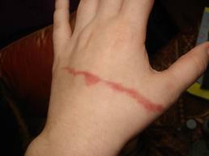 CARA ALAMI MENGHILANGKAN BEKAS LUKA PADA KULIT