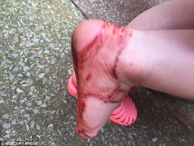 Awas! Luka Mengenaskan Ini Berasal dari Sepatu Sandal Jelly Awas! Luka Mengenaskan Ini Berasal dari Sepatu Sandal Jelly